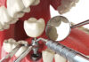 implanty zębów